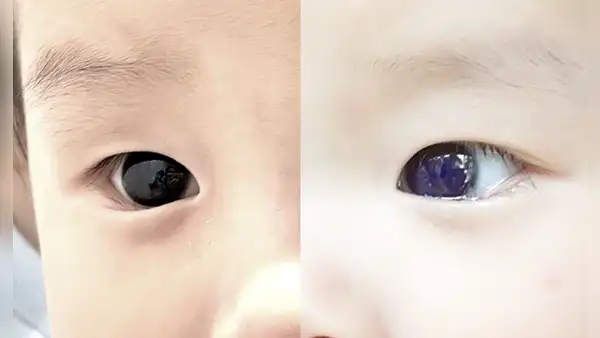 Color de ojos de bebé cambia tras recibir presunto fármaco contra la COVID-19