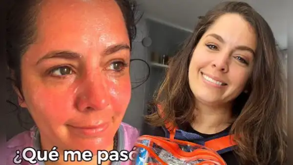 ¡Delicado! Yiddá Eslava sufre quemadura y preocupa a sus seguidores: ¿qué le pasó?