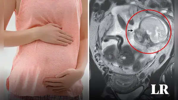 Fue al hospital por dolor de estómago y descubre que está embarazada: feto crecía en el intestino