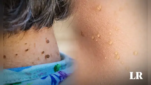 ¿Por qué me salen lunares de carne en el cuello o axilas y cómo eliminarlos? Especialistas lo explican