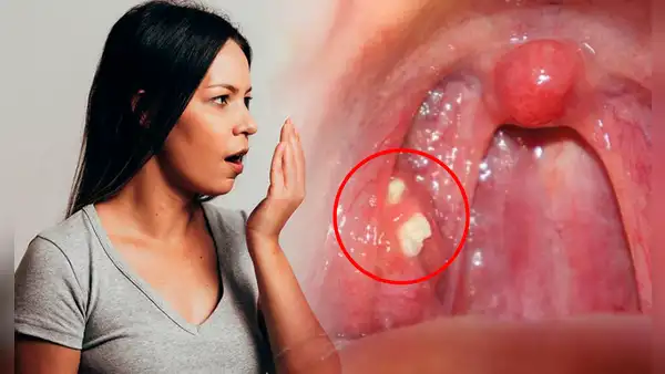 ¿Por qué me salen bolitas amarillas en la garganta y cómo puedo eliminarlas para no tener mal aliento?