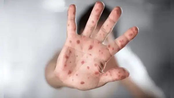 Minsa identifica caso importado de sarampión tras declarar alerta epidemiológica en el Perú