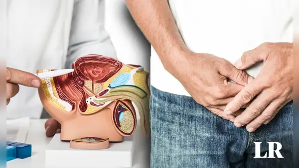 El cáncer de próstata es la primera causa de muerte de los hombres en Perú: ¿cómo prevenirlo?