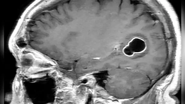 Médicos en EE. UU. encuentran larvas en el cerebro de hombre con migrañas