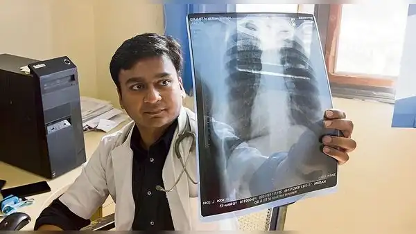 Cada año se reportan 30 mil casos de tuberculosis en el Perú