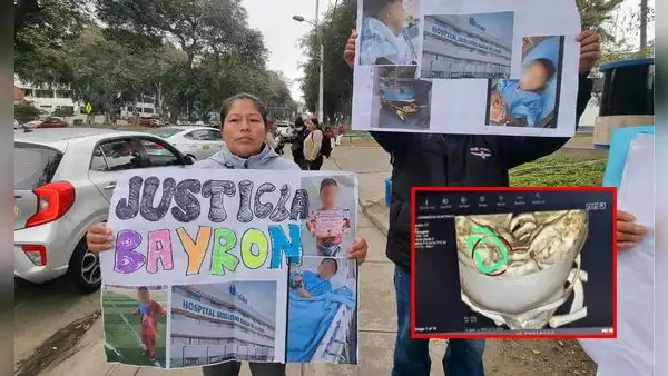 VMT: menor de 6 años va al dentista y termina con una aguja en la cabeza en hospital de Essalud