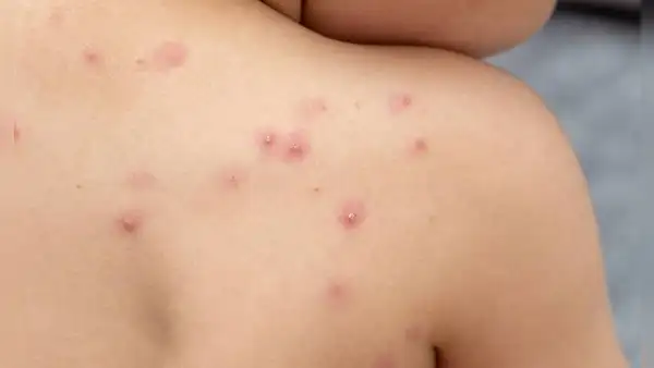 Síntomas de mpox y cómo se contagia: la enfermedad que ha causado más de 400 muertes en África este año