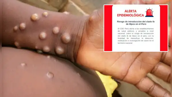 Minsa emite alerta epidemiológica a establecimientos de salud por nueva variante de la viruela del mono