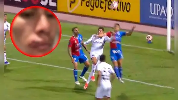 Así quedó el rostro del jugador de Melgar tras el codazo que recibió, por el que no cobraron penal