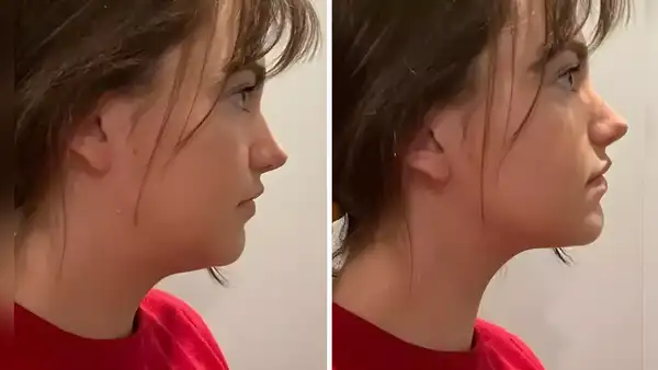 ¿Qué es el 'mewing'? El ejercicio viral de TikTok que promete transformar el rostro: elimina la papada y afina la mandíbula
