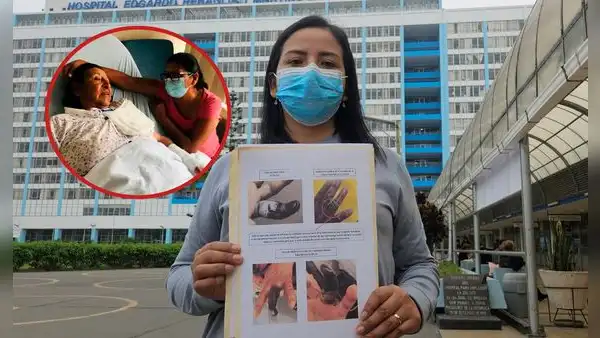"Mi madre entró por una fractura y terminó sin un dedo": denuncian presunta negligencia médica en hospital Rebagliati