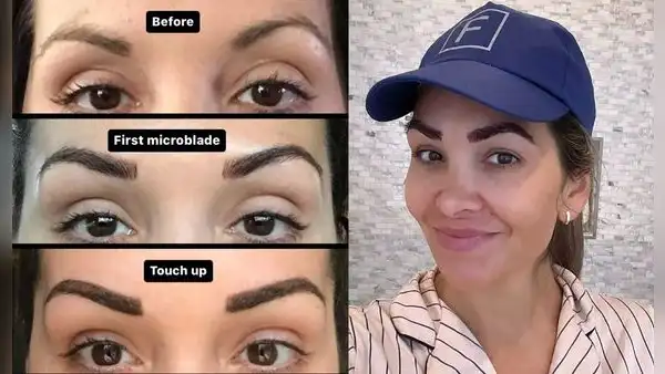 Mujer revela cómo un trasplante de cejas de más de US$5.000 le cambió la vida tras años de depilación excesiva: "Lo volvería a hacer"