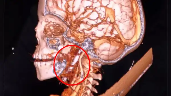 Niño de 7 años sobrevive a un terrible accidente en la India: un clavo de 3 pulgadas se incrustó en su cerebro