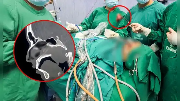 Sin abrir el cráneo, médicos de La Libertad extraen tumor nasal gigante a adolescente de 17 años