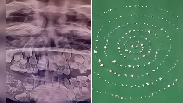 El insólito caso del menor que tenía 526 dientes en la mandíbula y se los extrajeron en una sola cirugía en la India