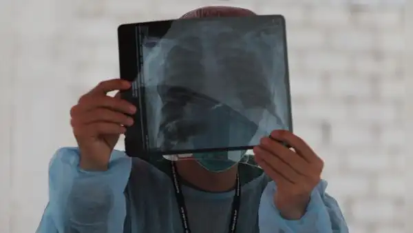 Perú es el país de América Latina con más casos de tuberculosis, según la OMS: Minsa reportó más de 33.000 pacientes en 2024