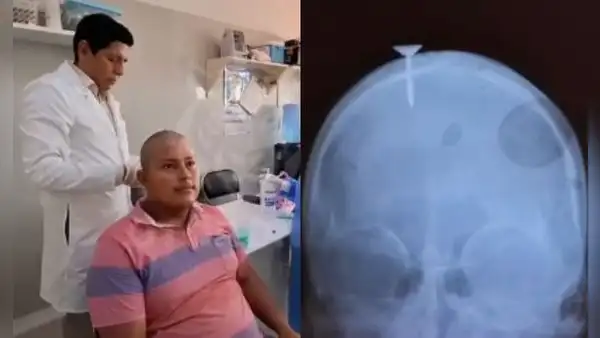 Obrero sobrevive a lesión en la cabeza ocasionada por clavo en Loreto: pistola neumática se activó por accidente