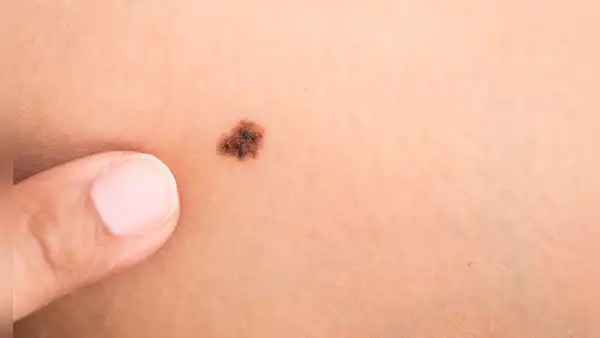 El melanoma en Perú: cómo reconocer a tiempo el cáncer de piel más agresivo