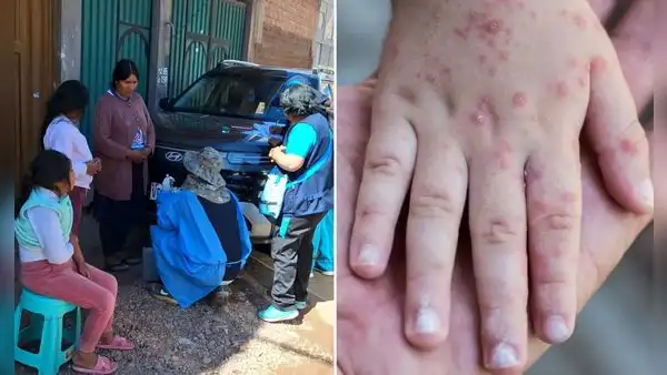 Brote de sarampión: casos se cuadruplican en solo tres días durante alerta sanitaria en Puno