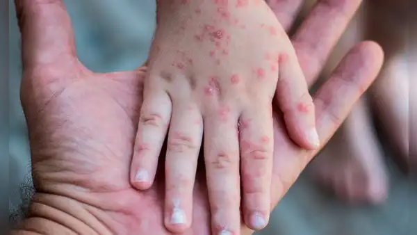 Casos de contagios por virus Coxsackie se duplicaron en colegios a nivel nacional, advierte el Minsa y Minedu