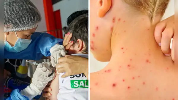 Gobierno declara emergencia sanitaria por brote de sarampión: Lima, Callao y 12 regiones más en alerta