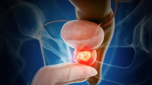 Ensayo clínico internacional demuestra eficacia de terapia combinada en cáncer de próstata agresivo: menos progresión y menor mortalidad