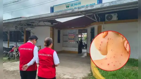 Sin fondos para emergencia por sarampión: pacientes en riesgo y posible aumento de contagios en Madre de Dios