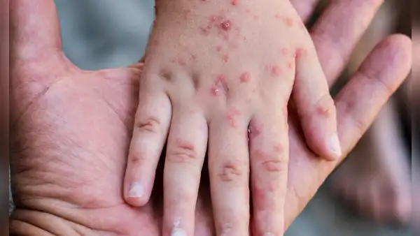 Amplían por 90 días emergencia sanitaria por brote de sarampión y riesgo de contagio en 11 regiones