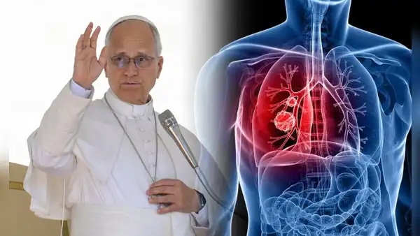 ¿El nódulo pulmonar del papa León XIV podría ser cáncer? Doctor Elmer Huerta qué es y qué riesgo existe en operación