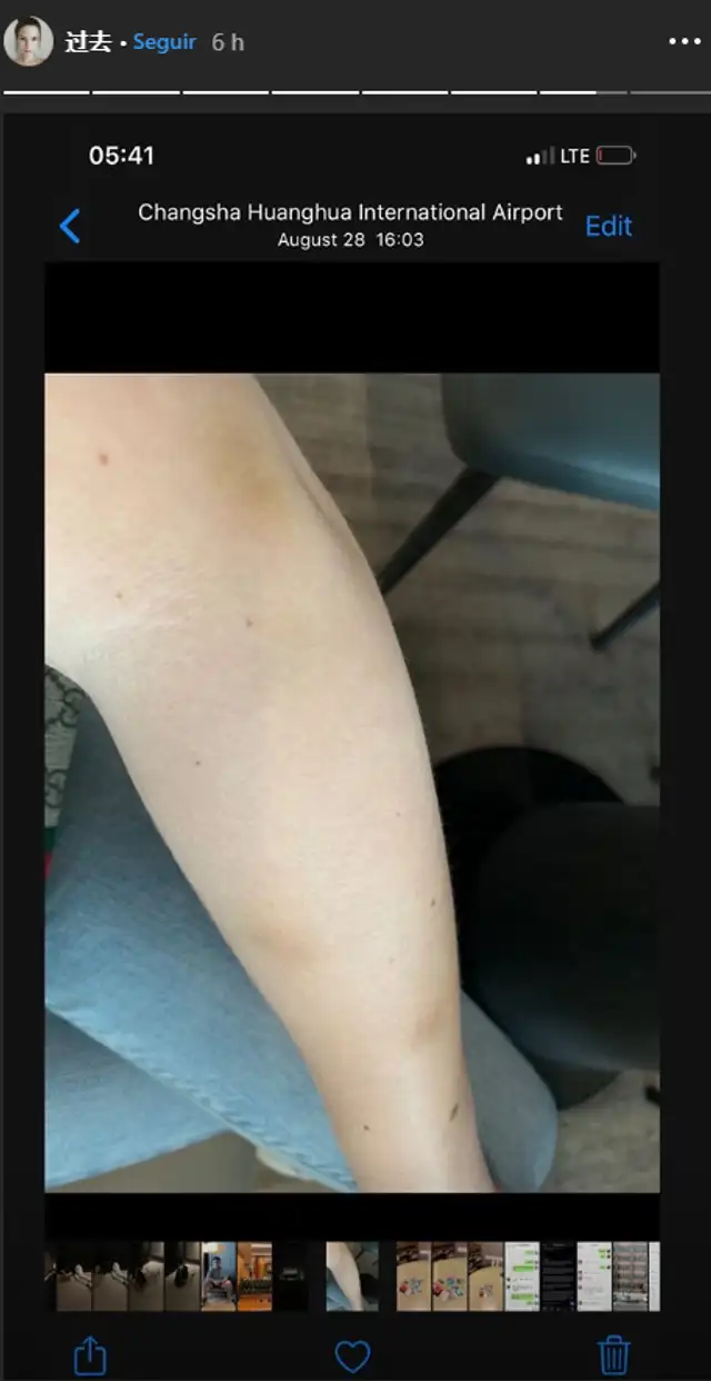 Joven publicó imágenes de las contusiones que le habría dejado el actor chino. Joven publicó imágenes de las contusiones que le habría dejado el actor chino.