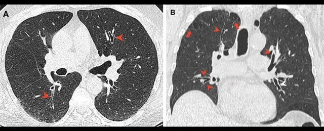 Tomografías pulmonares de un fumador de cannabis y tabaco de 66 años con graves daños en sus vías respiratorias. Foto: Radiology / Murtha et. al. (2022)