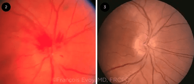  El ojo con NAION muestra edema del disco óptico, hemorragia en astilla peripapilar y estrechamiento de las arteriolas retinianas peripapilares, según la AAO. Foto: AAO   