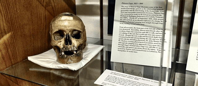 Cráneo de de Phineas Gage en el Warren Anatomical Museum en Boston. Foto: McGill   