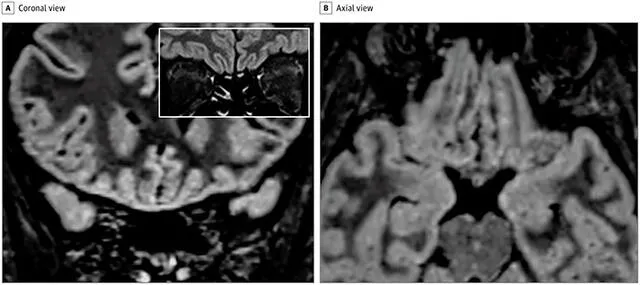 Imágenes que muestran la resolución completa de la alteración de la señal vista anteriormente dentro de la corteza del giro recto derecho. Foto: JAMA Neurology