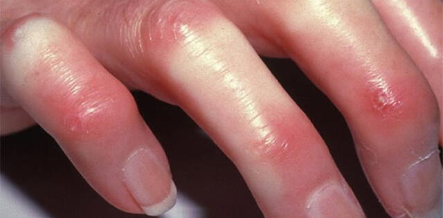 Una persona que posee esclerodermia en los dedos puede presentar estiramiento y enrojecimiento de la piel. (Foto: Biosalud)