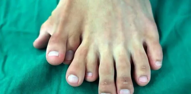 El pie del joven tenía 9 dedos.