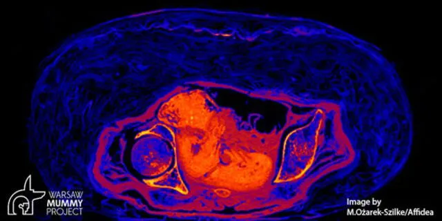 Imagen transversal del cuerpo de la momia, con el feto resaltado en rojo. Foto: Warsaw Mummy Project