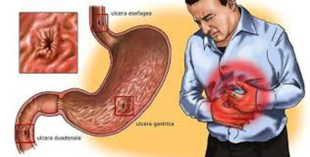 Las úlceras por estrés se producen debido a la falta de aire en los pacientes. (Foto: Psicogastro)