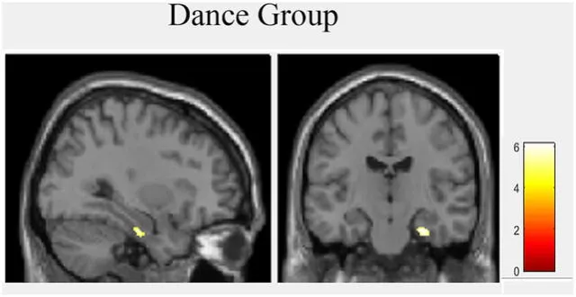  El estudio evidenció que bailar aumenta el volumen del hipocampo cerebral. Foto: Frontiers   