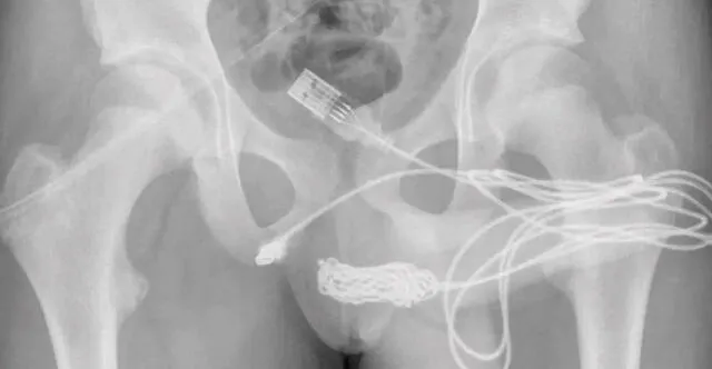 Los médicos tuvieron que operar al joven para retirar el cable USB | Foto: ScienceDirect