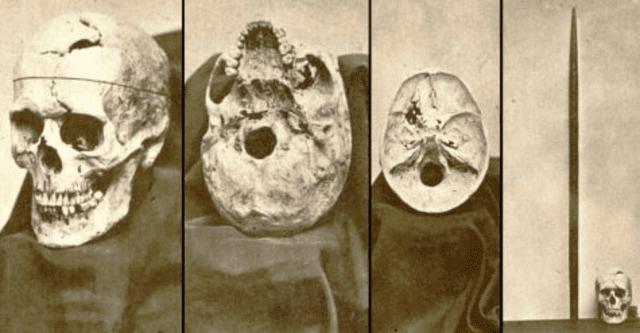 El cráneo de Phineas Gage entregado por su familia y que ahora es objeto de estudios. Foto: The Paw Print   