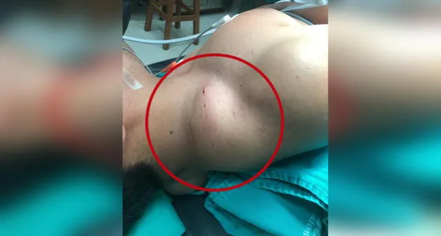 Tacna: Médicos extrajeron parásito de 10 centímetros que parecía un tumor [FOTOS]