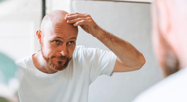 Hair loss treatments are very common in men than women. Photo: Freepik   