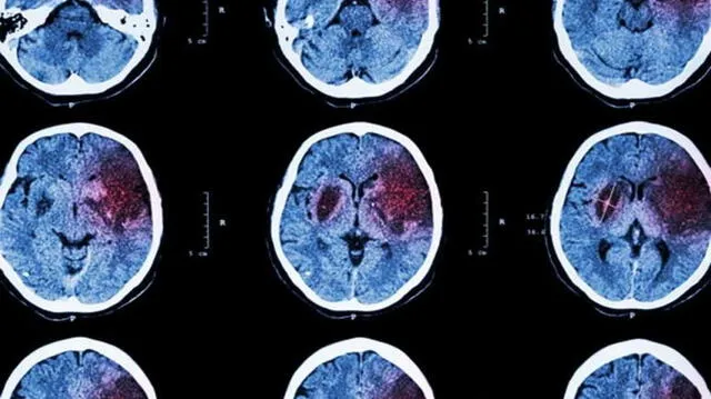 El derrame cerebral es también conocido como accidente cerebrovascular. Foto: Salud Movil.   