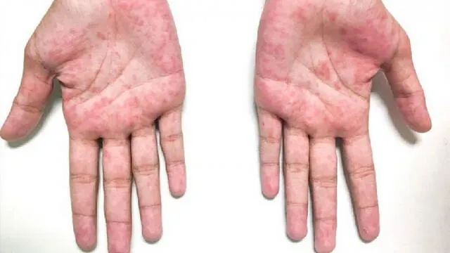El sarpullido en la piel se puede observar entre los síntomas de la enfermedad de Kawasaki. Foto: Difusión.