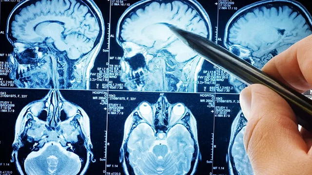 Tomografía de un cerebro con accidente cerebrovascular. Foto: Sutterstock