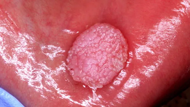 Tumor benigno de origen epitelial asociado al VPH que puede aparecer en la mucosa bucal, principalmente lengua, labios y paladar. Foto: Dental Tribune