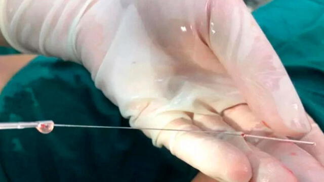 Le extrajeron la aguja en el hospital X'ian Children's. Foto: AsiaWire.