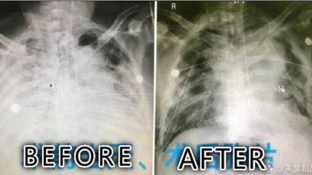 Antes y después del trasplante. Foto: China Science.