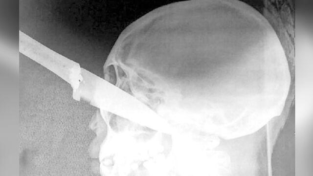 Radiografía que muestra el cuchillo en el ojo de la joven. Fuente: Expresión del Sur.
